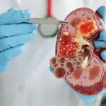 Common pain medication may protect kidney patients from dangerous toxins