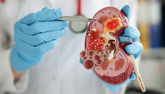 Common pain medication may protect kidney patients from dangerous toxins